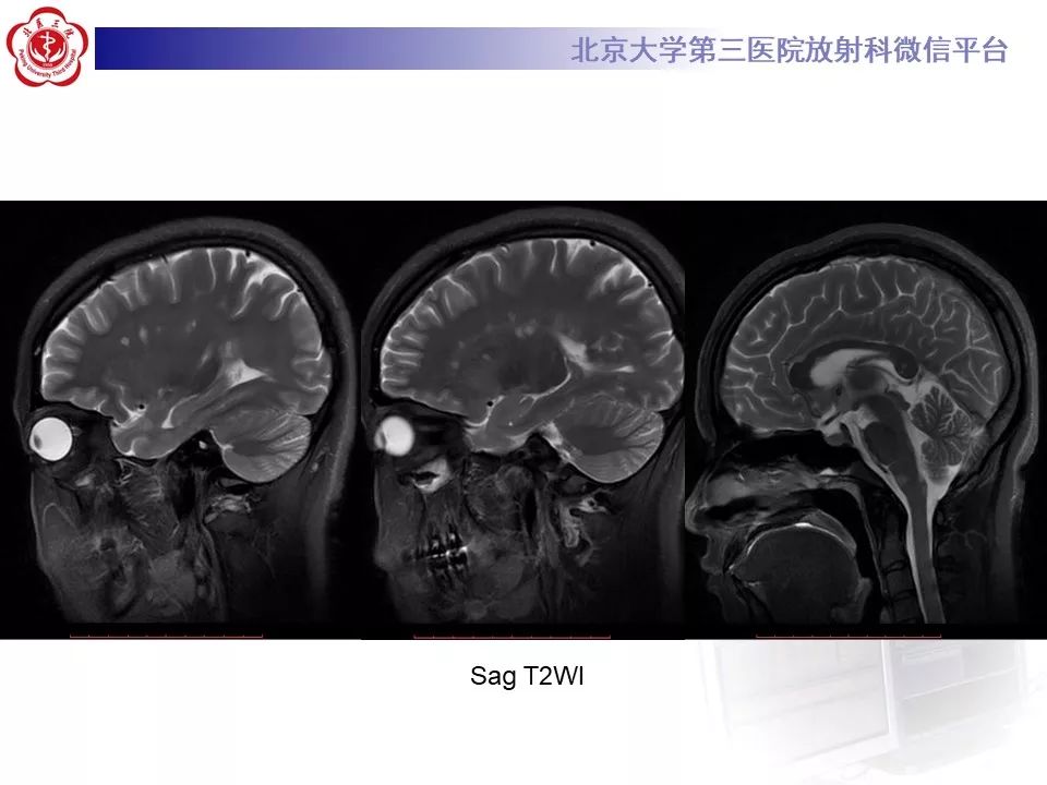 影像PPT - 【PPT】多发性硬化的影像-13