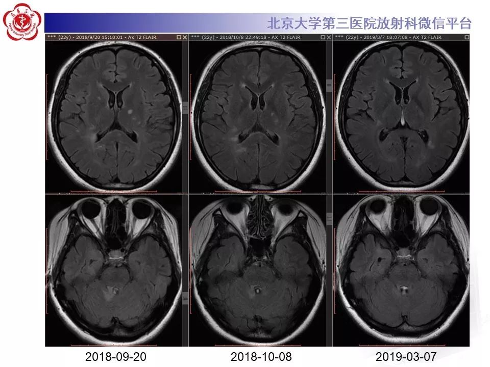 影像PPT - 【PPT】多发性硬化的影像-19