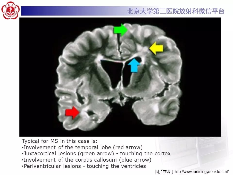 影像PPT - 【PPT】多发性硬化的影像-28