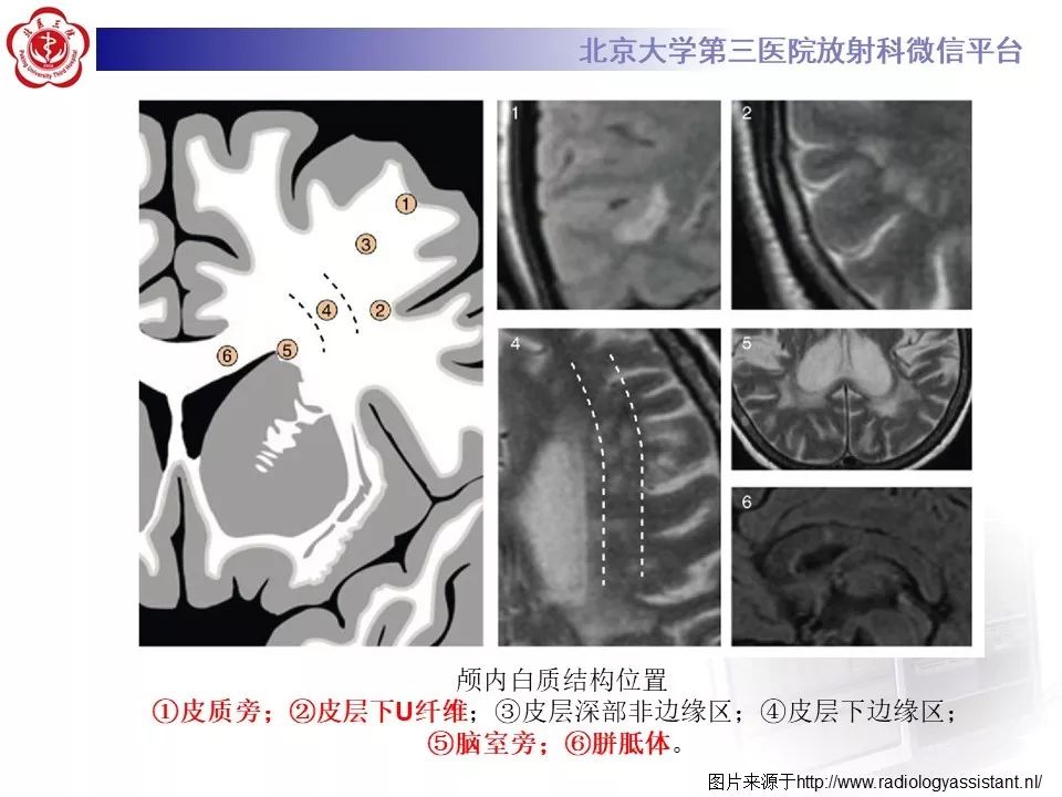 影像PPT - 【PPT】多发性硬化的影像-29
