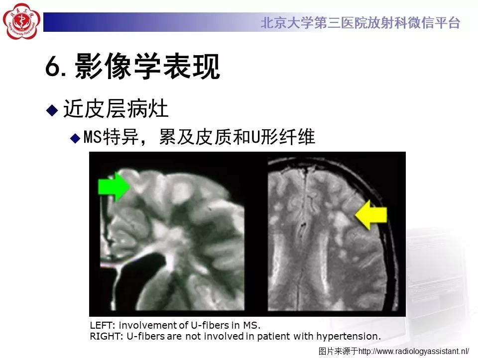 影像PPT - 【PPT】多发性硬化的影像-30