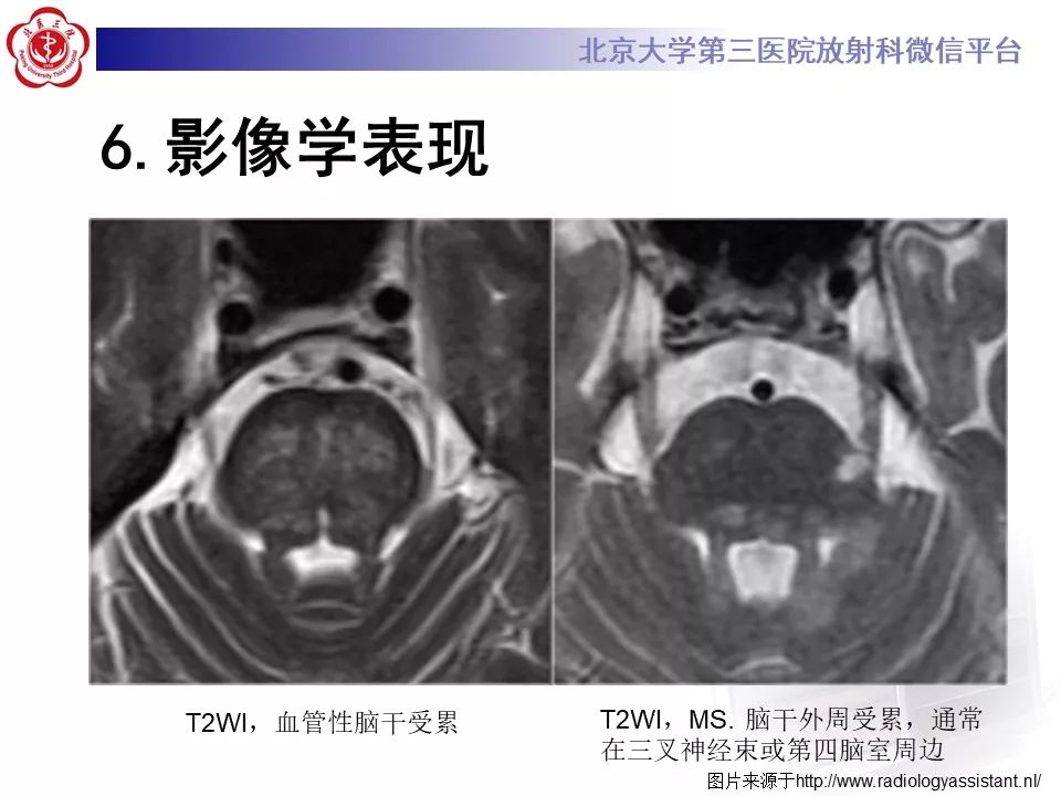 影像PPT - 【PPT】多发性硬化的影像-31