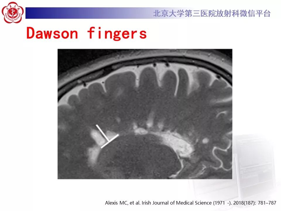 影像PPT - 【PPT】多发性硬化的影像-33