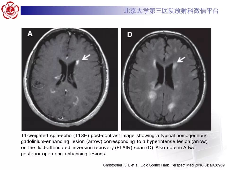 影像PPT - 【PPT】多发性硬化的影像-34