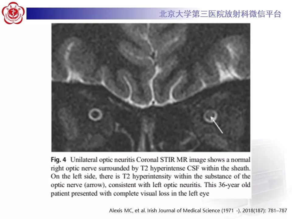 影像PPT - 【PPT】多发性硬化的影像-37