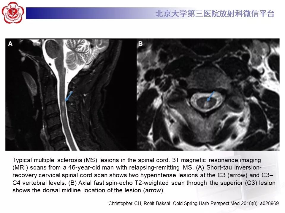影像PPT - 【PPT】多发性硬化的影像-36
