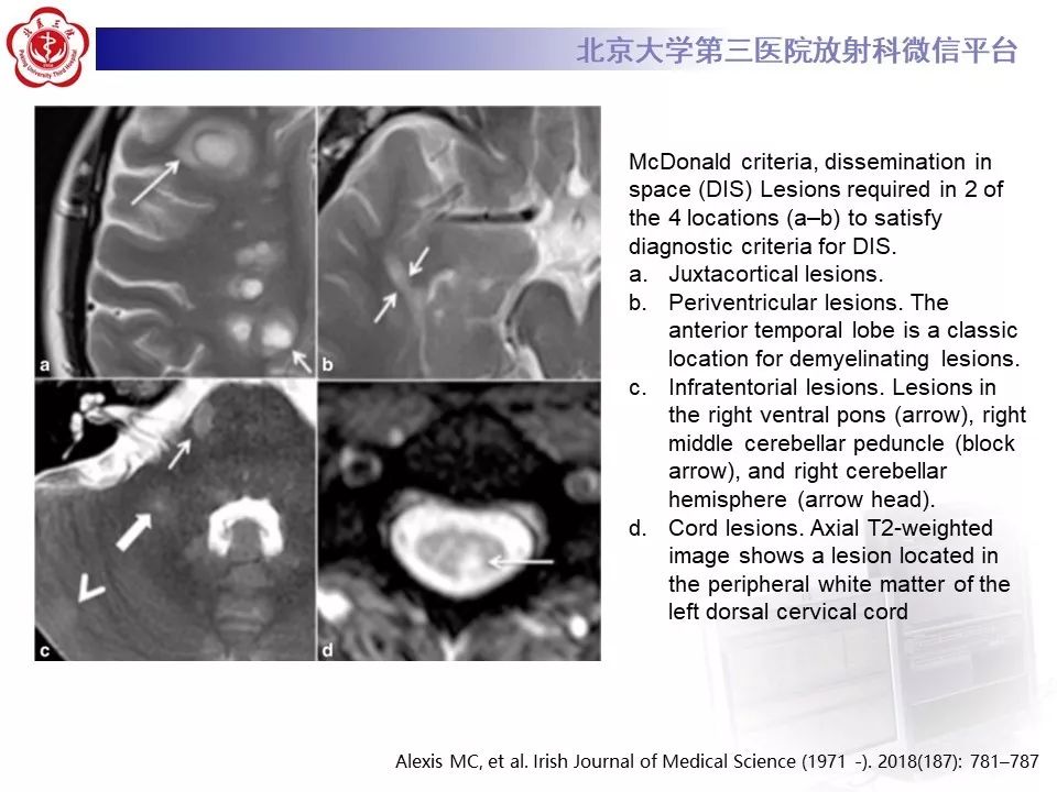 影像PPT - 【PPT】多发性硬化的影像-40