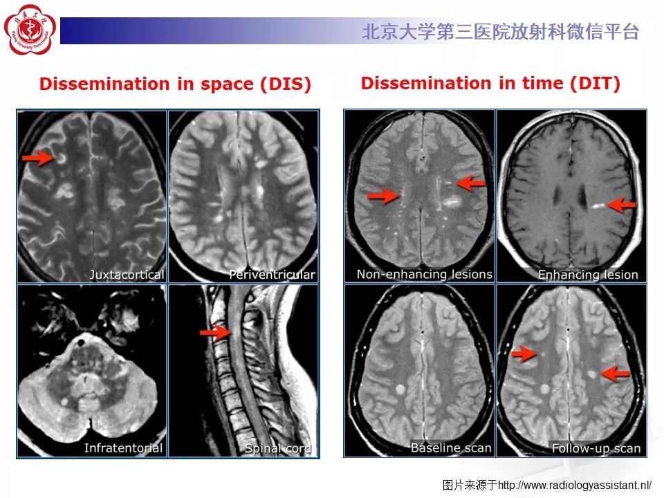 影像PPT - 【PPT】多发性硬化的影像-39