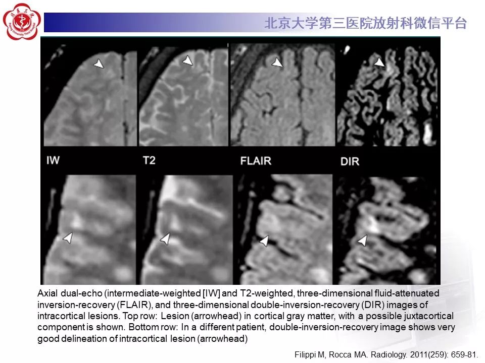 影像PPT - 【PPT】多发性硬化的影像-42