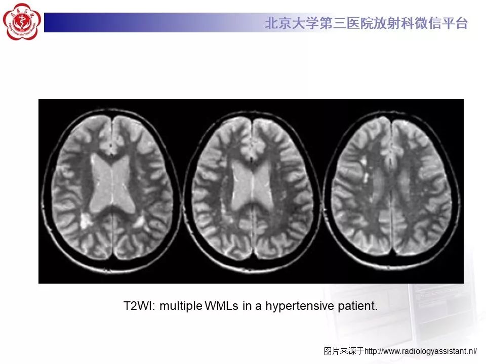 影像PPT - 【PPT】多发性硬化的影像-49