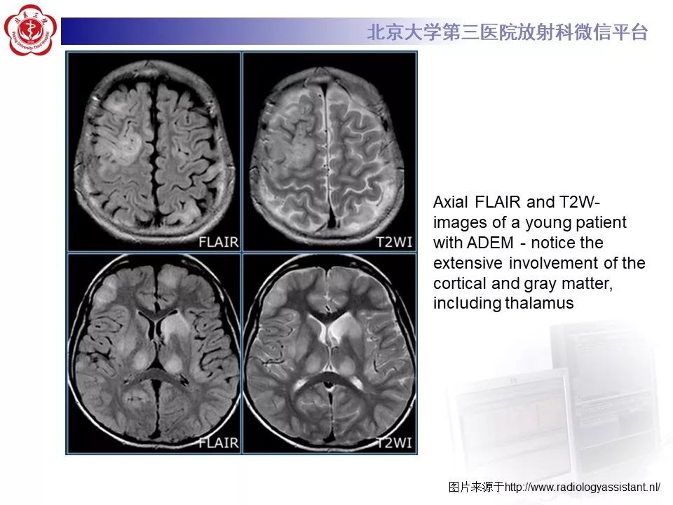 影像PPT - 【PPT】多发性硬化的影像-51