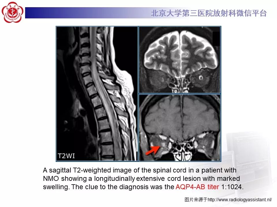 影像PPT - 【PPT】多发性硬化的影像-53