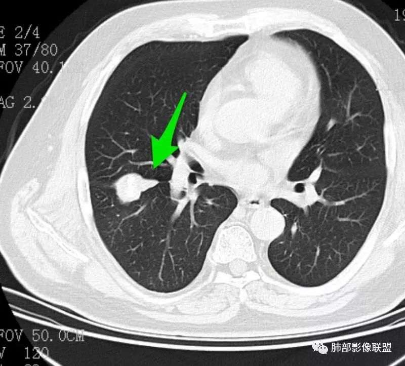 影像PPT - 【病例】叶间肿块伴钙化—孤立性纤维瘤1例CT影像-43 影像PPT - 【病例】叶间肿块伴钙化—孤立性纤维瘤1例CT影像-43
