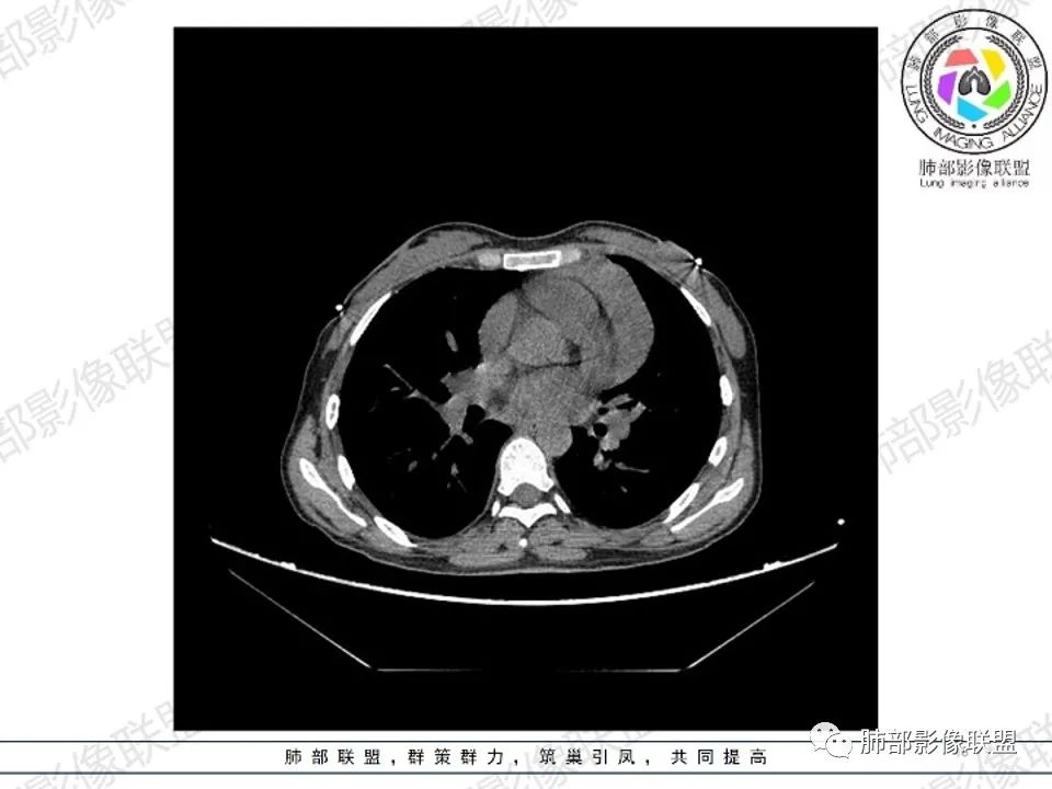 影像PPT - 【病例】 扑朔迷离的 Castleman病-18 影像PPT - 【病例】 扑朔迷离的 Castleman病-18