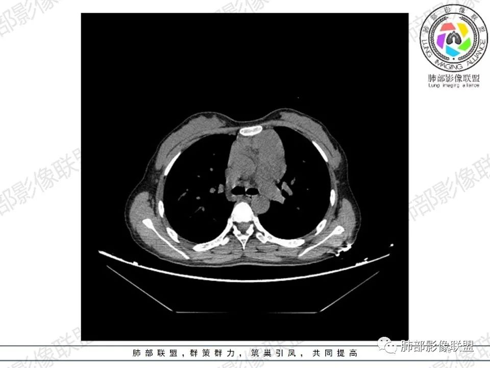 影像PPT - 【病例】 扑朔迷离的 Castleman病-13 影像PPT - 【病例】 扑朔迷离的 Castleman病-13