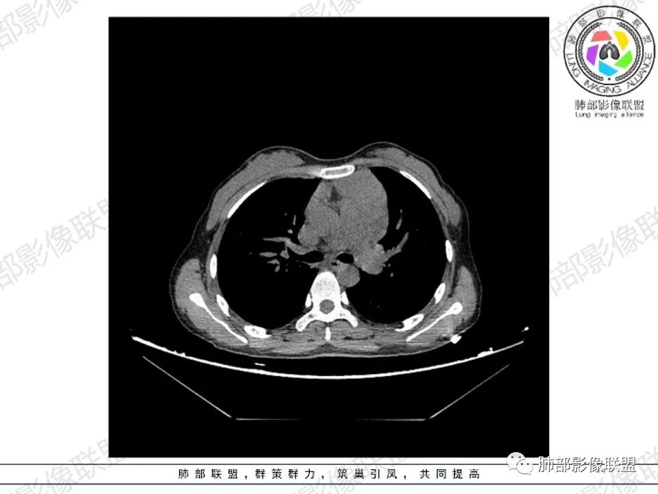 影像PPT - 【病例】 扑朔迷离的 Castleman病-14 影像PPT - 【病例】 扑朔迷离的 Castleman病-14