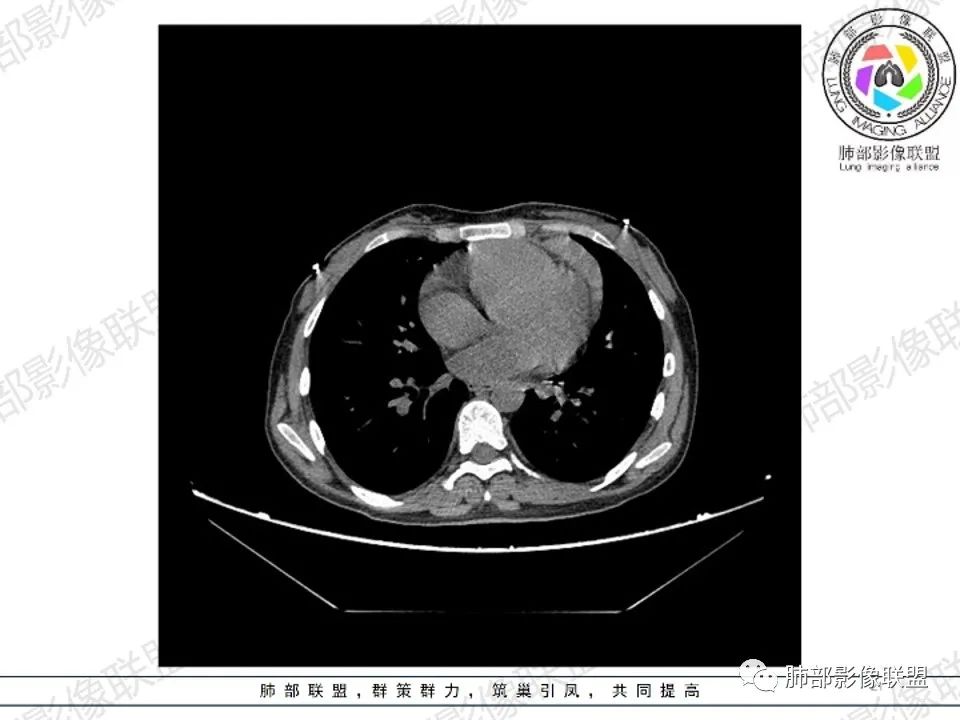 影像PPT - 【病例】 扑朔迷离的 Castleman病-21 影像PPT - 【病例】 扑朔迷离的 Castleman病-21
