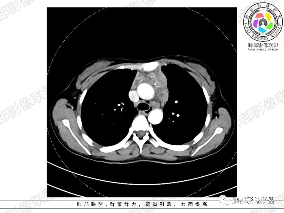 影像PPT - 【病例】 扑朔迷离的 Castleman病-32 影像PPT - 【病例】 扑朔迷离的 Castleman病-32