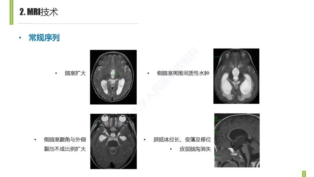 影像PPT - 【PPT】梗阻性脑积水MRI诊断-6
