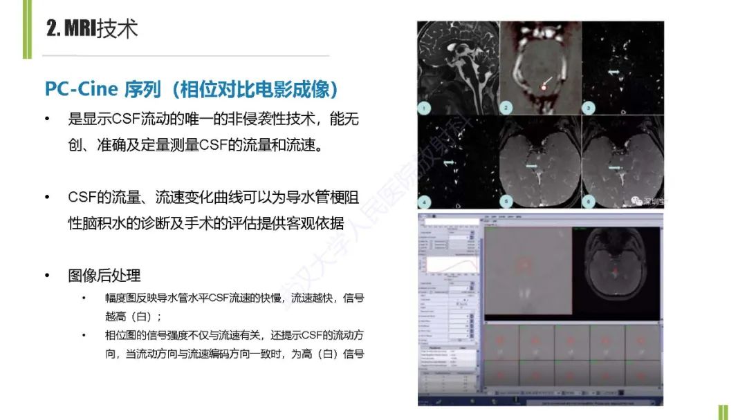 影像PPT - 【PPT】梗阻性脑积水MRI诊断-9