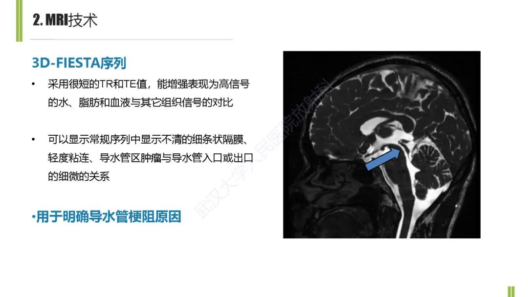 影像PPT - 【PPT】梗阻性脑积水MRI诊断-7