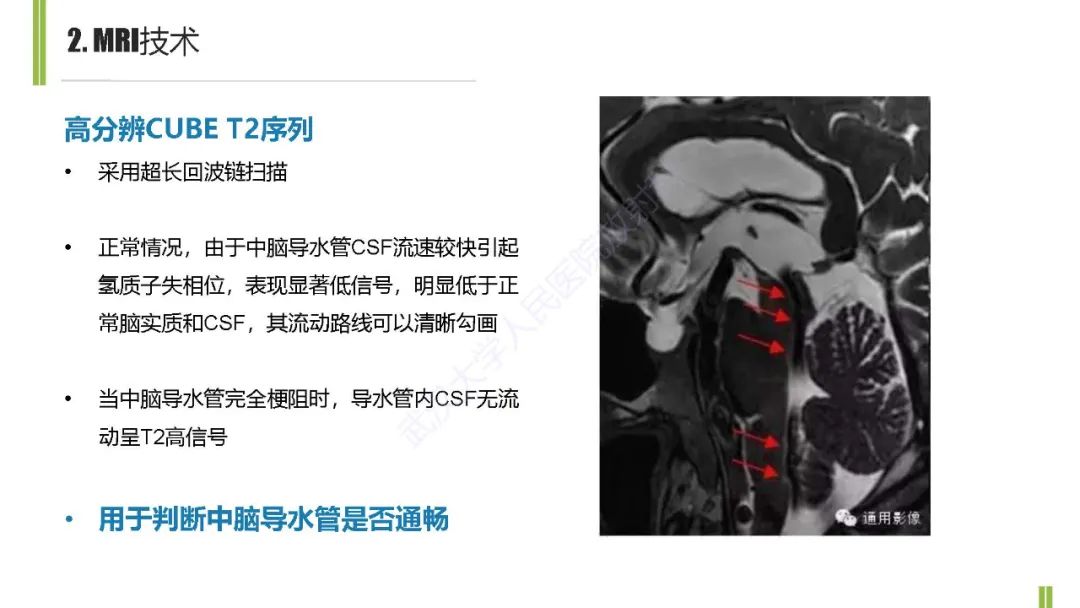 影像PPT - 【PPT】梗阻性脑积水MRI诊断-8