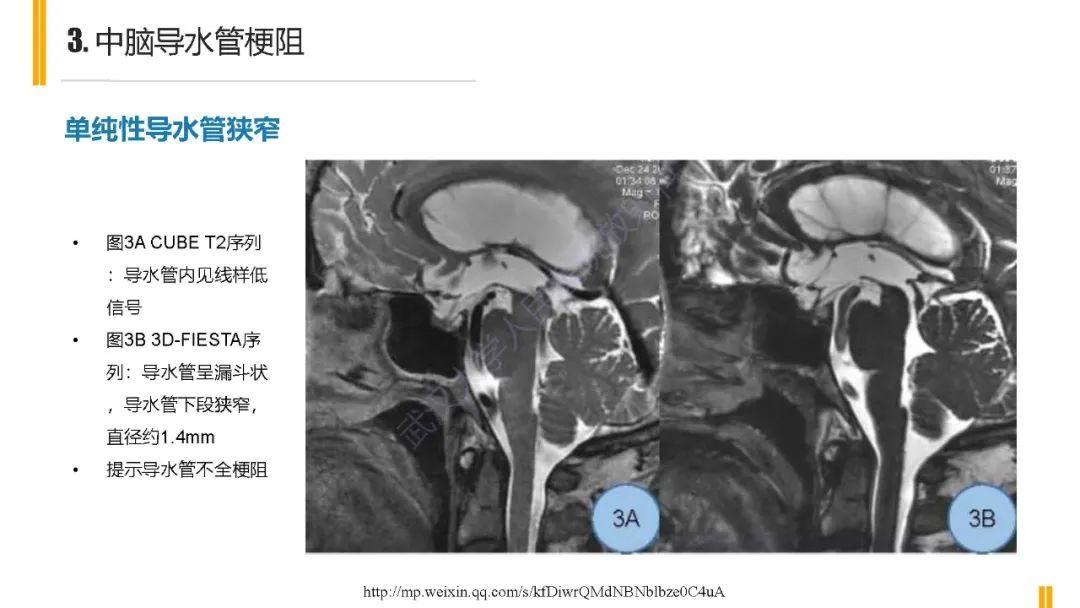 影像PPT - 【PPT】梗阻性脑积水MRI诊断-11