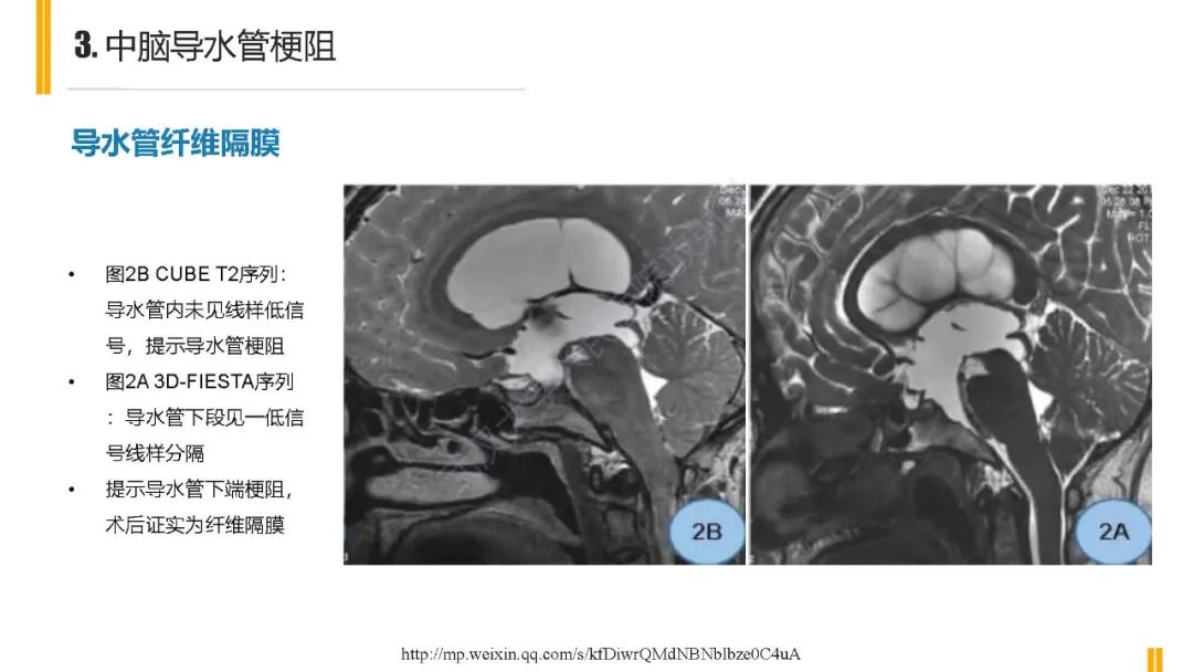 影像PPT - 【PPT】梗阻性脑积水MRI诊断-12