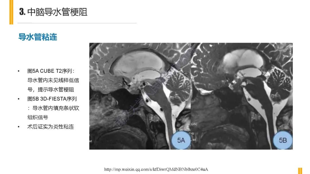 影像PPT - 【PPT】梗阻性脑积水MRI诊断-13