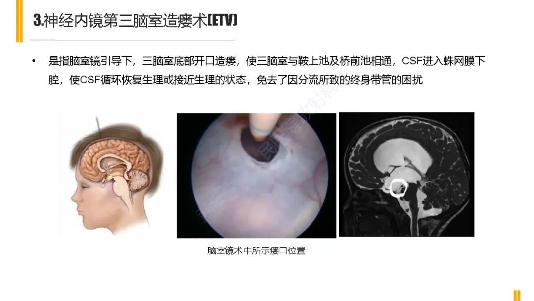 影像PPT - 【PPT】梗阻性脑积水MRI诊断-15
