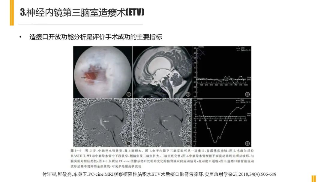 影像PPT - 【PPT】梗阻性脑积水MRI诊断-16