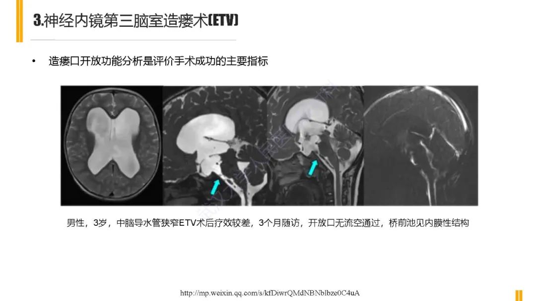 影像PPT - 【PPT】梗阻性脑积水MRI诊断-18