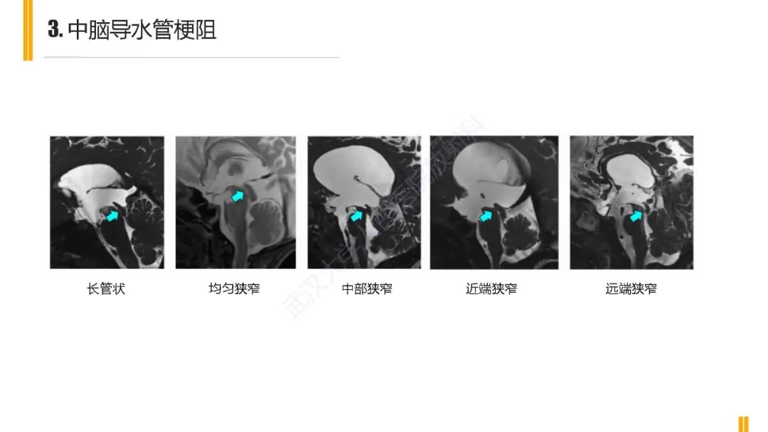 影像PPT - 【PPT】梗阻性脑积水MRI诊断-14