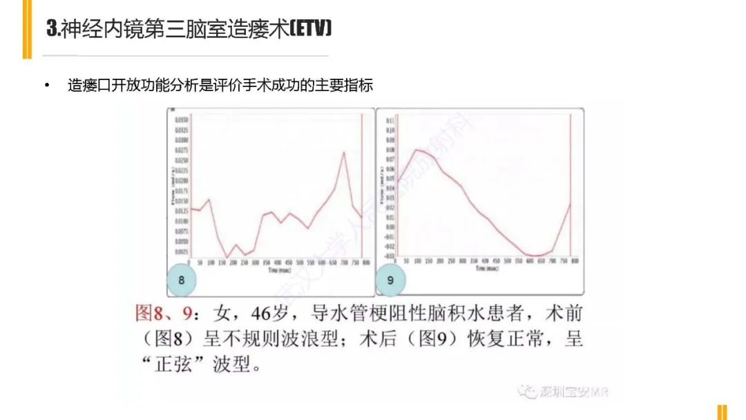 影像PPT - 【PPT】梗阻性脑积水MRI诊断-17