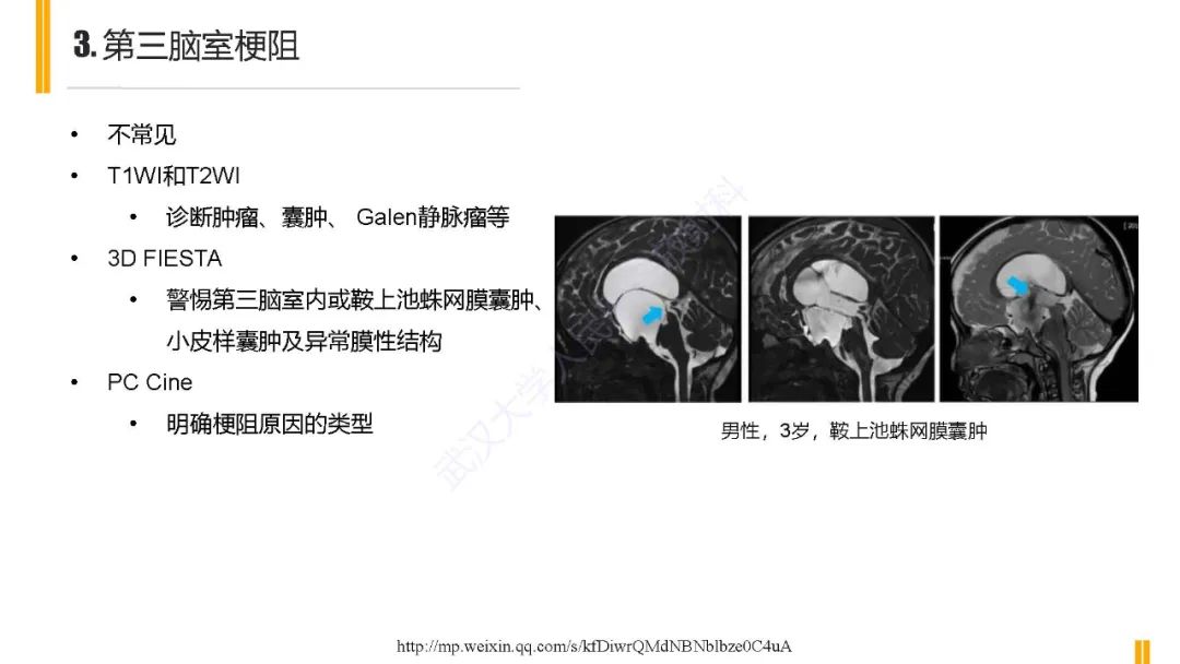 影像PPT - 【PPT】梗阻性脑积水MRI诊断-20