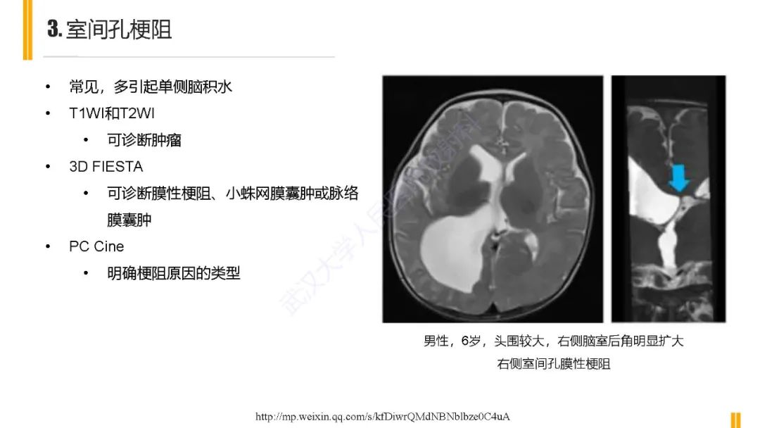 影像PPT - 【PPT】梗阻性脑积水MRI诊断-19