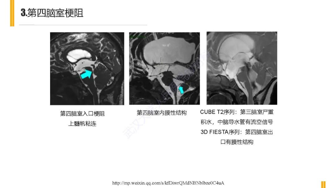 影像PPT - 【PPT】梗阻性脑积水MRI诊断-21