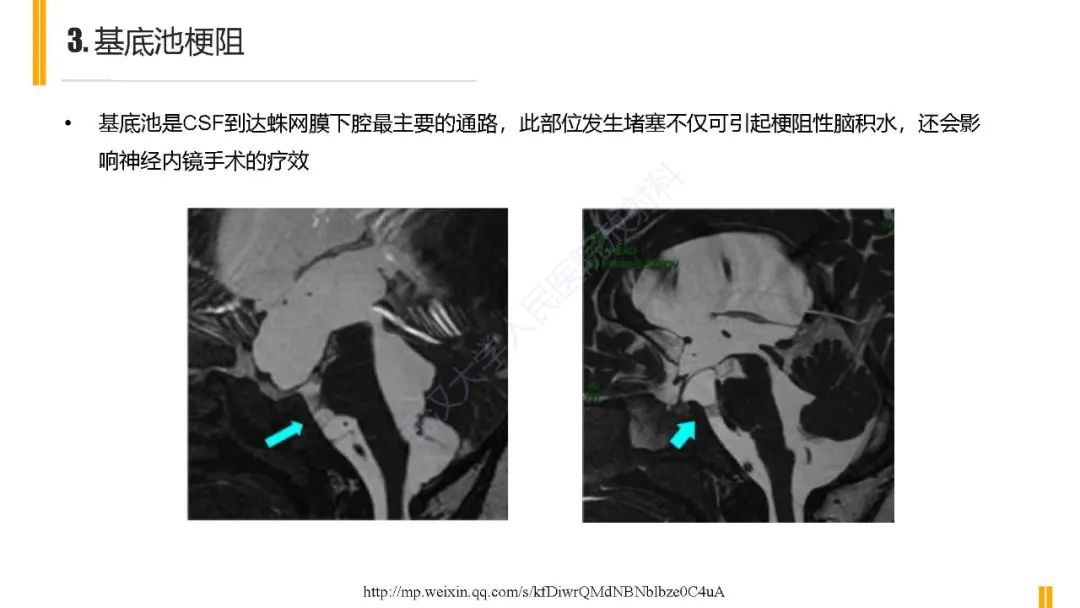 影像PPT - 【PPT】梗阻性脑积水MRI诊断-23