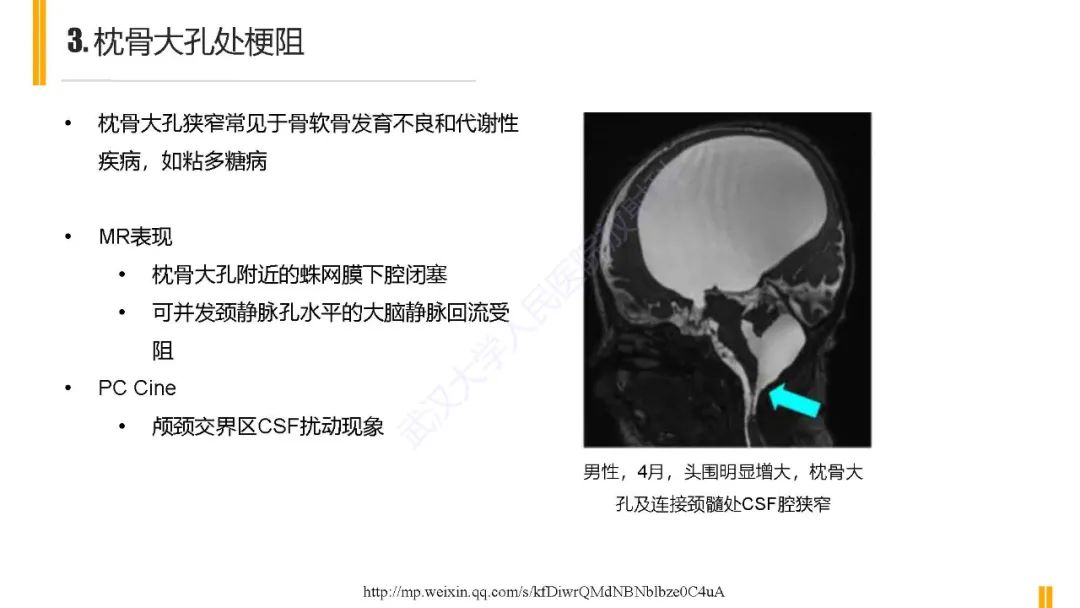 影像PPT - 【PPT】梗阻性脑积水MRI诊断-22