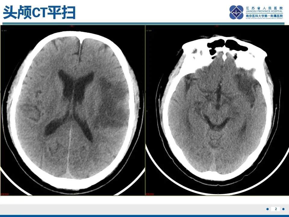 影像PPT - 【PPT】颈动脉蹼-4