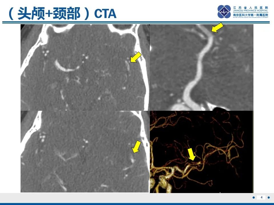 影像PPT - 【PPT】颈动脉蹼-6