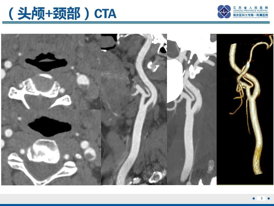 影像PPT - 【PPT】颈动脉蹼-5