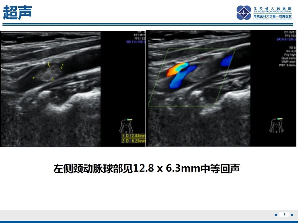 影像PPT - 【PPT】颈动脉蹼-7