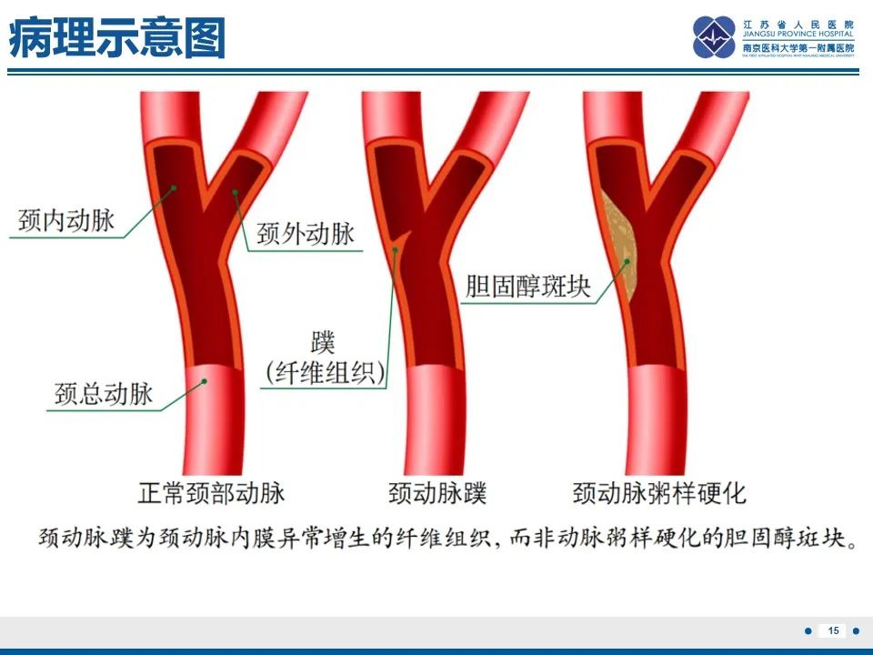 影像PPT - 【PPT】颈动脉蹼-17