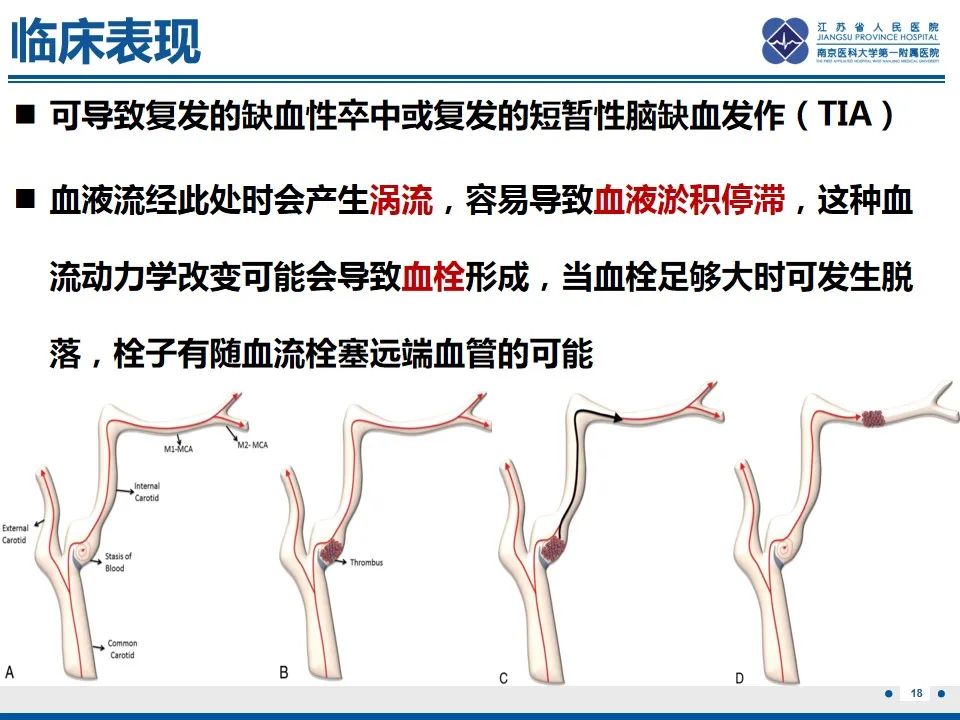 影像PPT - 【PPT】颈动脉蹼-20