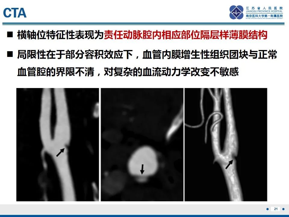 影像PPT - 【PPT】颈动脉蹼-23