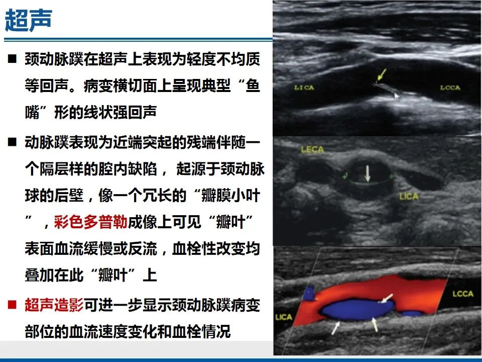 影像PPT - 【PPT】颈动脉蹼-22