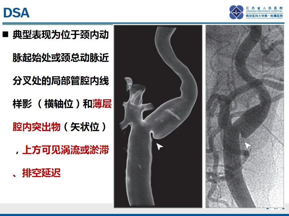 影像PPT - 【PPT】颈动脉蹼-25