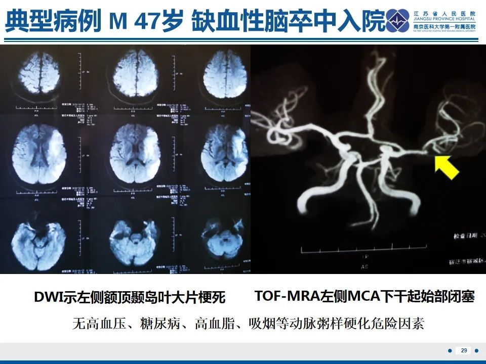 影像PPT - 【PPT】颈动脉蹼-31