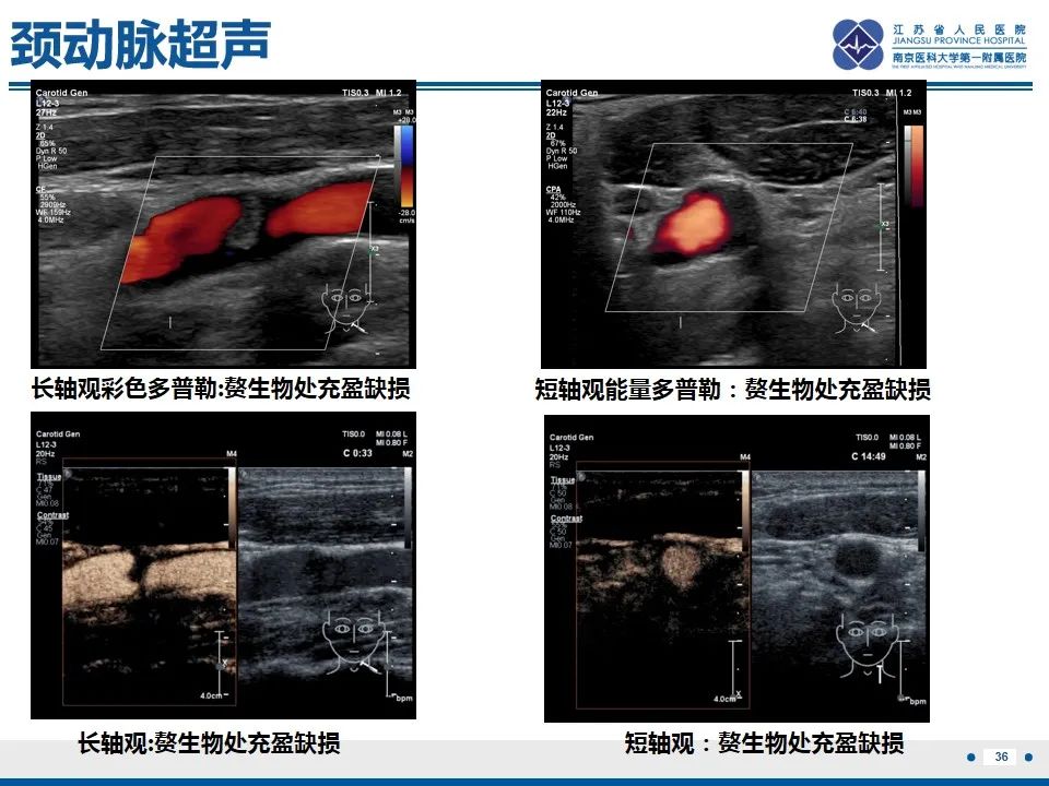 影像PPT - 【PPT】颈动脉蹼-38